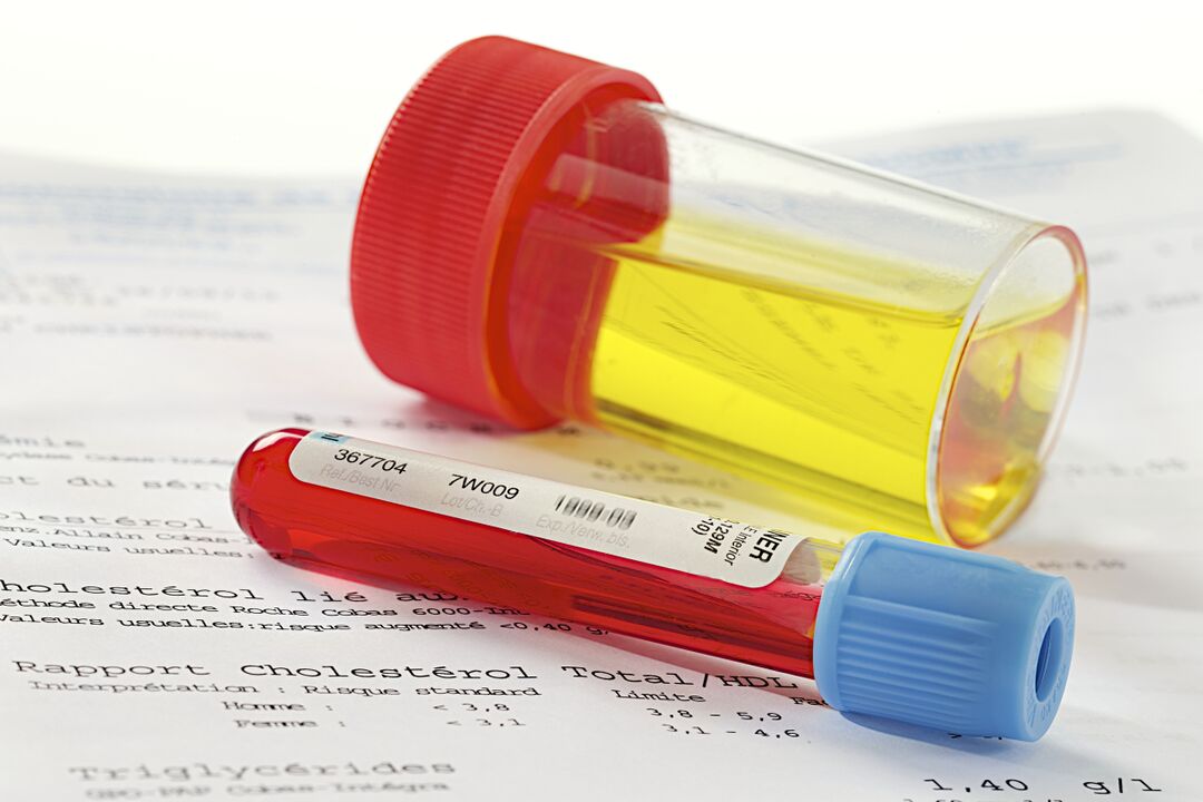 E Blutt an Urin Test hëlleft d'Präsenz vu Prostatitis ze bestëmmen.