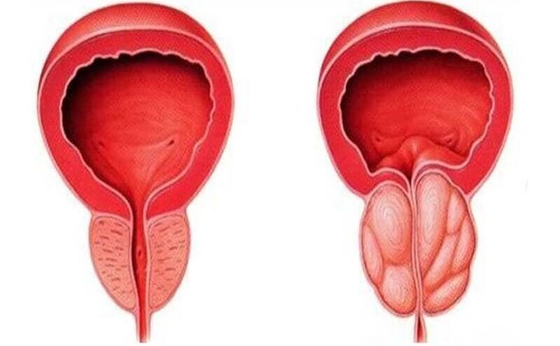 gesond an entzündete Prostata mat Prostatitis