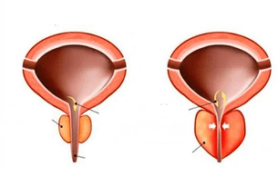 wat ass akut Prostatitis