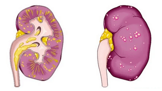 wat verursaacht akut Prostatitis