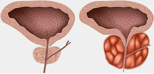 wat ass Prostatitis