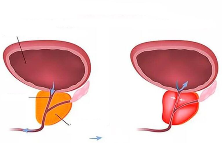 normal an entzündete Prostata