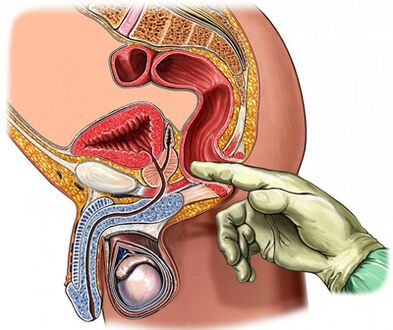 Fanger Prostatauntersuchung