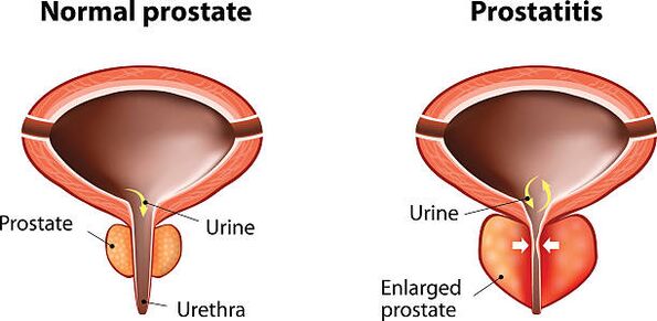 normal an entzündete Prostata