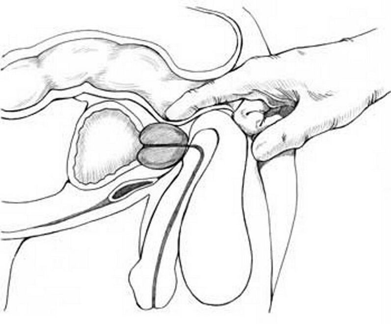 Prostatamassage fir chronesch Prostatitis