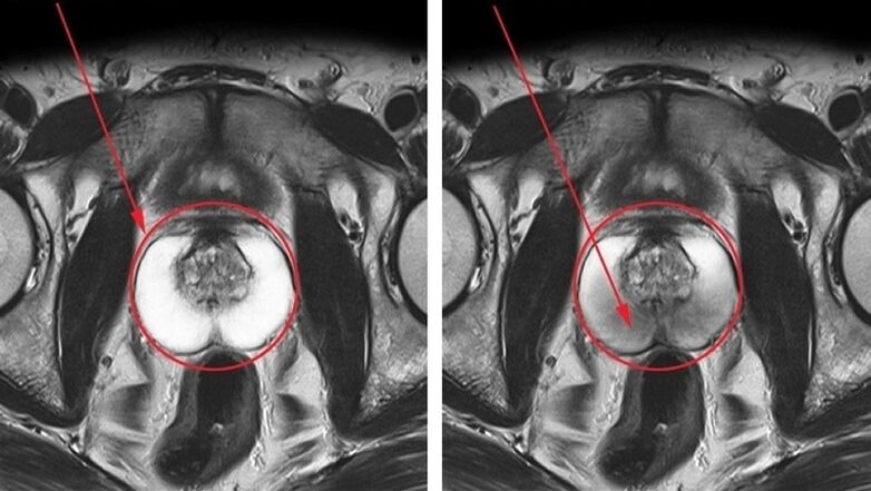 eng gesond an entzündegt Prostata mat chronescher Prostatitis