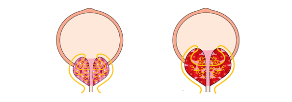 gesond an entzündegt Prostata mat Prostatitis